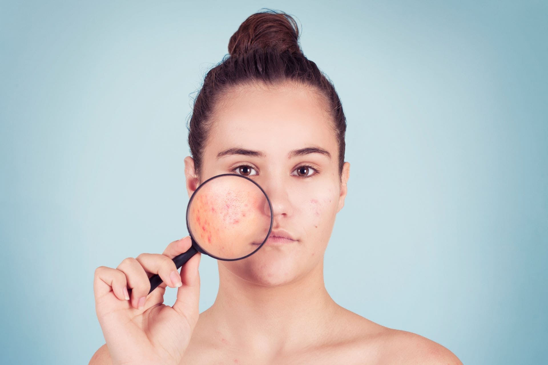 What You Need To Know About Acne And How To Treat It