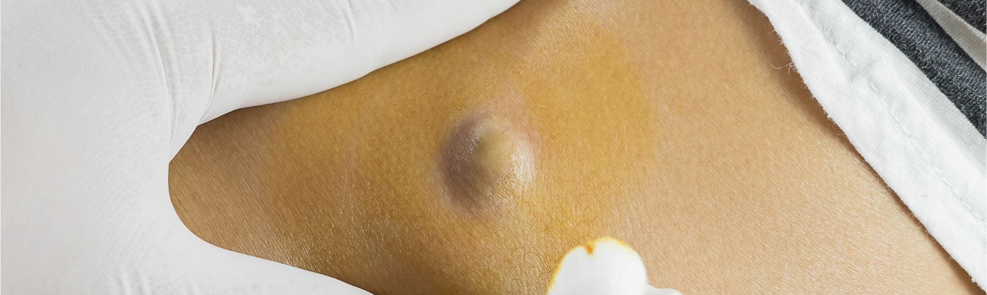 Can A Dermatologist Remove A Cyst