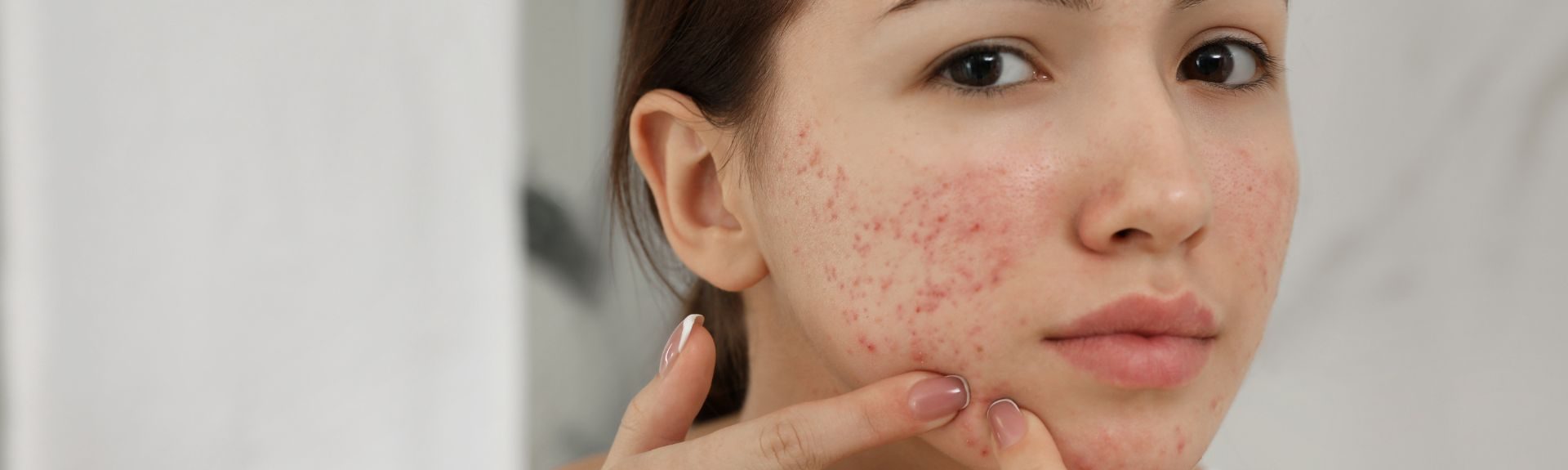Can a dermatologist help with acne