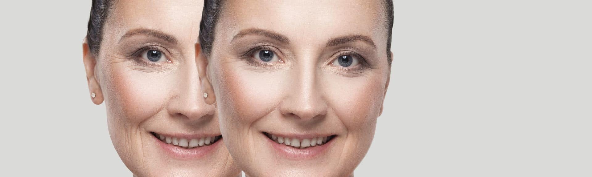 How Botox Works To Reduce The Appearance Of Wrinkles