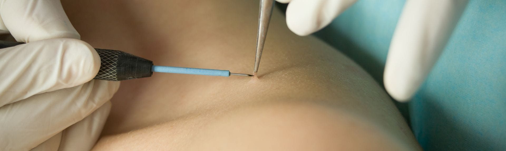 How Do Dermatologists Remove Warts