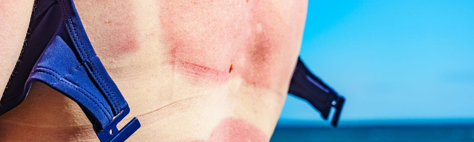 skin sun damage
